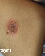 Image result for Ecthyma Cured Scar