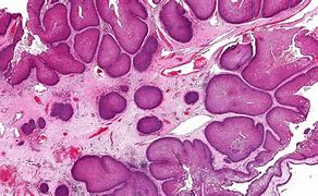 Image result for Sinonasal Papilloma Inverted Type Gross