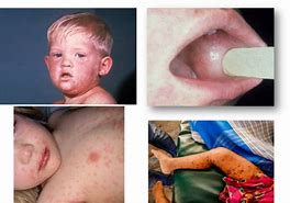 Image result for Fifth Disease Kids