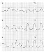 Image result for Anterior Wall Myocardial Infarction