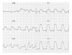 Image result for Possible Anterior Myocardial Infarction ECG