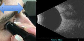 Image result for Eye Ultrasound