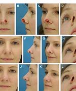 Image result for Nose Cartilage Surgery