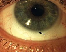 Image result for Contact Lenses for Astigmatism