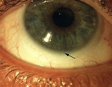 Image result for Contact Lenses for Astigmatism