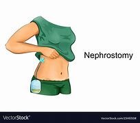 Image result for Nephrostomy Drainage Color