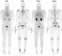 Image result for Nuclear Medicine Bone Scan