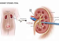 Image result for 7Mm Kidney Stone Proximal in Ureter