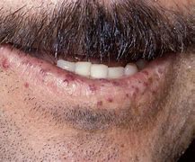 Image result for choroba_rendu oslera webera