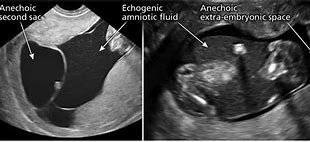 Image result for Anencephaly 8 Week Ultrasound