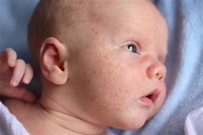 Image result for Babies with Pimples