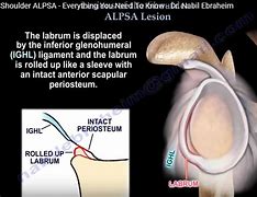 Image result for alpsa