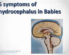 Image result for Hydrocephalus Signs