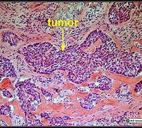 Image result for Skin Cancer Under Microscope