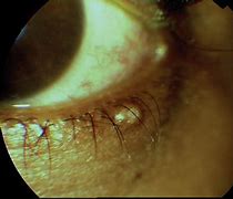 Image result for Molluscum Contagiosum On Eyelid