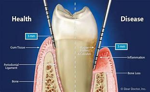 Image result for Gingival and Periodontal Pocket