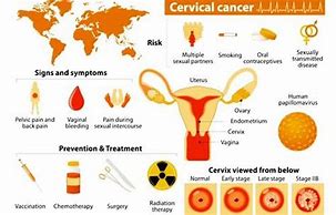 Image result for Cervical Cancer Treatment
