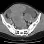 Image result for Largest Ovarian Tumor