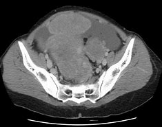 Image result for Ovarian Cyst On X-ray