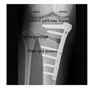 Image result for Hto Osteotomy