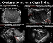 Image result for Chaocolate Cyst of Ovary