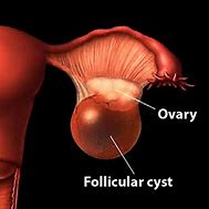 Image result for Ovarian Follicular Cyst
