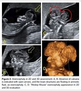 Image result for Anencephaly Mickey Mouse