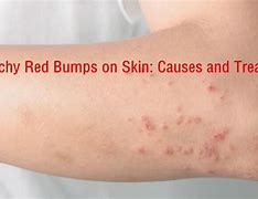 Image result for Red Rashes On Skin