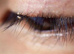 Image result for Eyelash Lice