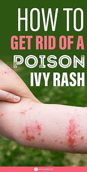 Image result for Get Rid of Poison Ivy Rash