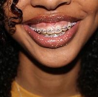 Image result for Burgundy Braces Teeth