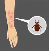 Image result for Allergic Bed Bug Bites