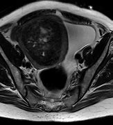 Image result for Uterine Fibroid On CT