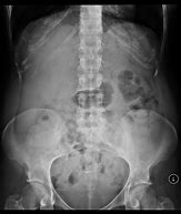 Image result for Abdomen X-Ray