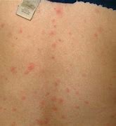 Image result for Flu Rash Symptoms