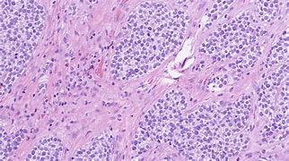 Image result for Round Cell Sarcoma