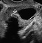 Image result for Teorema Ovary Ultrasound