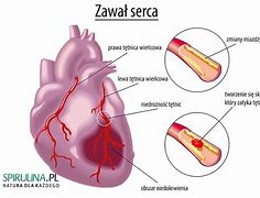 Image result for co_to_znaczy_zawał_serca