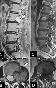 Image result for Schwannoma Tumor On Spine Surgery