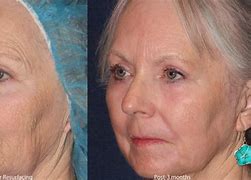 Image result for Aging Skin Rejuvenation