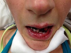 Image result for Broken Jaw Bone