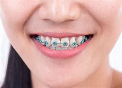 Image result for Braces Rubber Band Colors