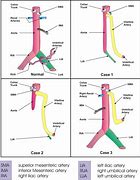 Image result for Sirenomelia Fetal