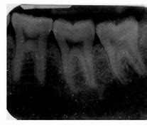 Image result for Over Exposed Dental Film