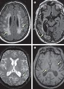 Image result for Vascular Dementia MRI