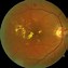 Image result for Diabetes Retina