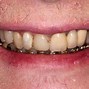 Image result for Reconstructed Smiles