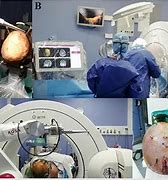 Image result for Eye Surgery Robot