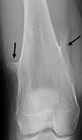 Image result for Exophytic Osteochondroma