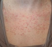 Image result for Keratosis pilaris